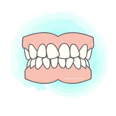 mordida-apinamiento-ortodoncia