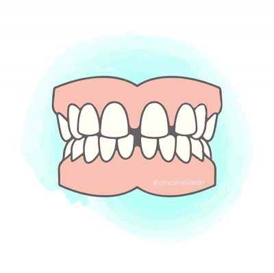 mordida-diastema-ortodoncia